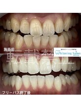 ホワイトニングサロン 福岡天神店/ホワイトニング