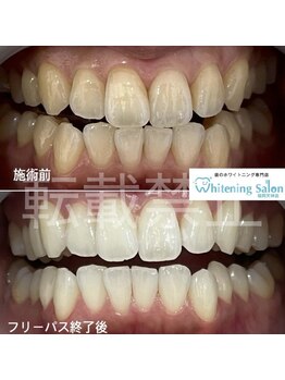 ホワイトニングサロン 福岡天神店/ホワイトニング