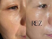 順蘭堂/毛穴洗浄ビフォー