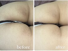 レシェルサロン(Lechelle Salon)/ハーブピーリングお尻