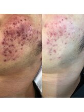 フーレスト アンド フリーリー(Fullest&Freely)/韓国発OHLハーブピーリング 