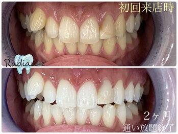 札幌セルフホワイトニング ラディアンス(Radiance)/2ヶ月通い放題