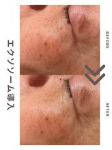 エステティックサロン ラ ベルタ(Esthetic Salon La Belta)/エクソソーム導入