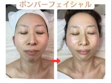 コトハ(cottha)/1回施術後