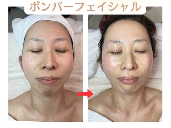 コトハ(cottha)/1回施術後