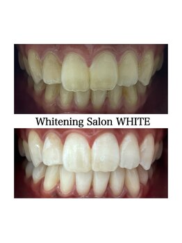 ホワイトニングサロン ホワイト 天童店(WHITE)/隙間時間にホワイトニング