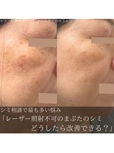 アウラプラス(Aura+)/塗るだけシミケア症例/3ヵ月