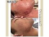 【ニキビ】毛穴洗浄＆殺菌◎ 日に日に増えるニキビ！まずは減らすことから！