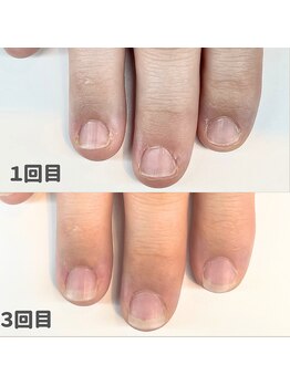ココデネイル(cocode nail)/爪噛み、形が悪い