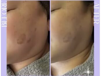 リラクゼーションサロン ラキ(laki)/スキンメイド/トロイアルケ