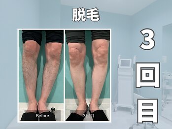 エックス(X)/【脱毛】驚異の脱毛パワー！