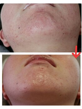 ベビースキン(baby skin)/肌改善