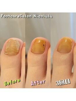 分厚い爪ビフォーアフター