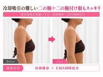 オリエンタルローザ 表参道(Oriental Rosa)/冷却痩身×EMSで二の腕華奢見え