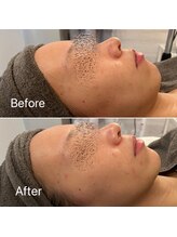 ブルームーン(Blue Moon)/ララピール　施術前後