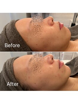 ブルームーン(Blue Moon)/ララピール 施術前後