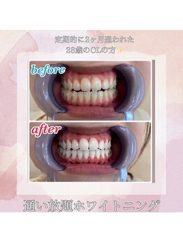 エクシアホワイトニング 明石店/ビフォーアフター