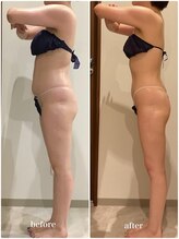 クラヴェル(Clavel)/30代前半セルゼロ2症例