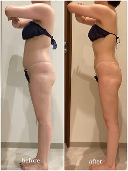 クラヴェル(Clavel)/30代前半セルゼロ2症例