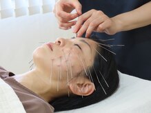 【ルート鍼灸×鬼美容鍼×よもぎ蒸し】首肩こり/腰痛/小顔《せせらぎ鍼灸院》