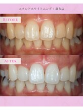 エクシアホワイトニング 調布店/30代女性会員様/笑顔に自信！