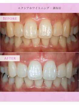 エクシアホワイトニング 調布店/30代女性会員様/笑顔に自信!