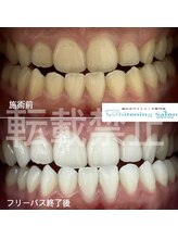 ホワイトニングサロン 福岡天神店/ホワイトニング