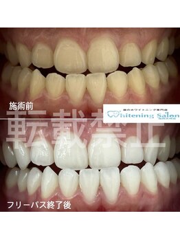 ホワイトニングサロン 福岡天神店/ホワイトニング