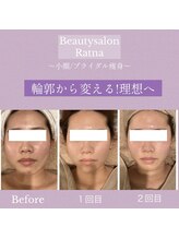 ラトナ(Ratna)/＃マイクロリフト導入店