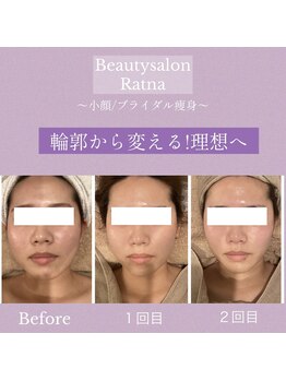 ラトナ(Ratna)/#マイクロリフト導入店