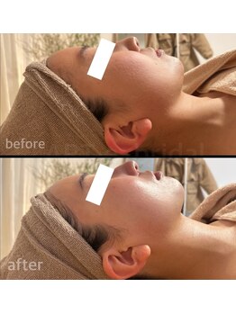 アルテ(ART-e)/Before/Afterプレ花嫁様1day