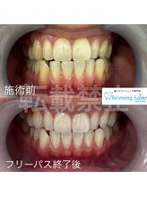 ホワイトニングサロン 福岡天神店/ホワイトニング