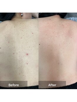 モカ 天王寺店(MOKA)/背中ハーブピーリング