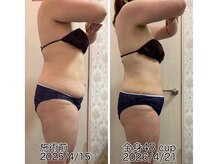 クールスパ(COOL SPA)/40代女性 お腹症例