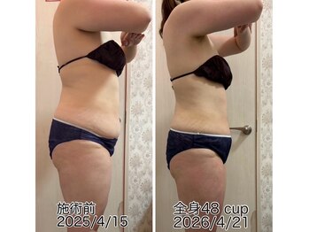 クールスパ(COOL SPA)/40代女性 お腹症例