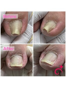 Dr.巻き爪 天神院/40代男性、痛みが消えました！