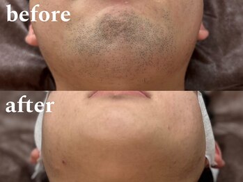 ボス 津店(BOSS)/【メンズ脱毛/ヒゲ脱毛】