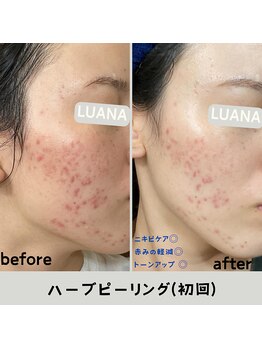 ルアナ 北谷店/ハーブピーリング 《沖縄/北谷》