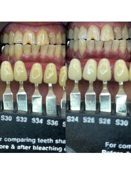 トウキョースワーズ 渋谷店(TOKYO SWRS)/#ホワイトニング #渋谷 #池袋
