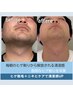 【青ヒゲ×ニキビ改善】ヒゲ脱毛＆毛穴集中ケア /越谷