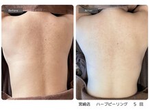 エミルカ 宮崎店(EMILUCA)/【クーポン有】背中症例