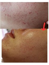 ベビースキン(baby skin)/肌改善