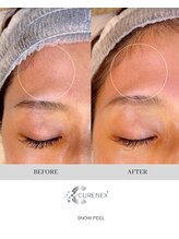 トータルクリア(TOTAL CLEAR)/雪花ピール大人気！