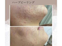 ベルーテ 田町三田(Bellute)/つるつるな肌になりたい方必見★