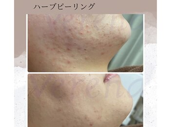 ベルーテ 田町三田(Bellute)/つるつるな肌になりたい方必見★