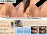 【毛穴洗浄+無針水光注入】最高濃度の美容液を注入し肌質改善☆乾燥/肌荒れに