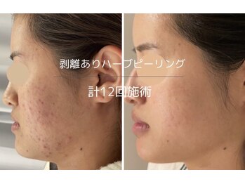 ライフ美容整体院 恵比寿(Life美容整体院)/ハーブピーリング