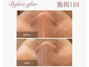 パルタージュ 三宮(Partage)/お手軽に毛穴洗浄体験♪