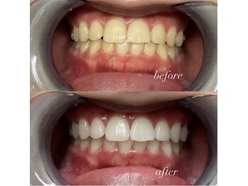 ホワイトニングセンター 大阪羽曳野店/最近の歯科ホワイトニングお客様
