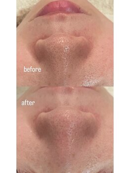 シャレール アリオ鷲宮店(Chareir)/小鼻毛穴洗浄/before→after
